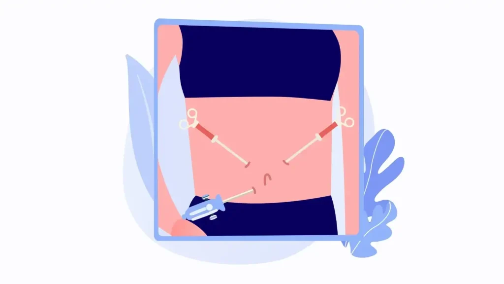 Laparoscopy