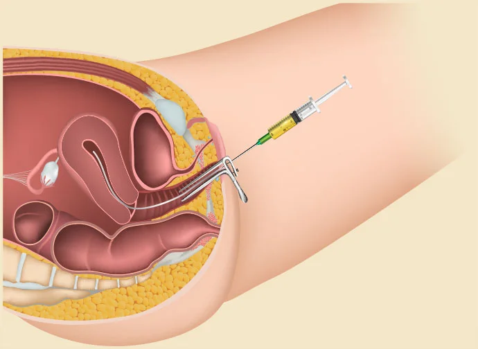 Intra-uterine Insemination (IUI)